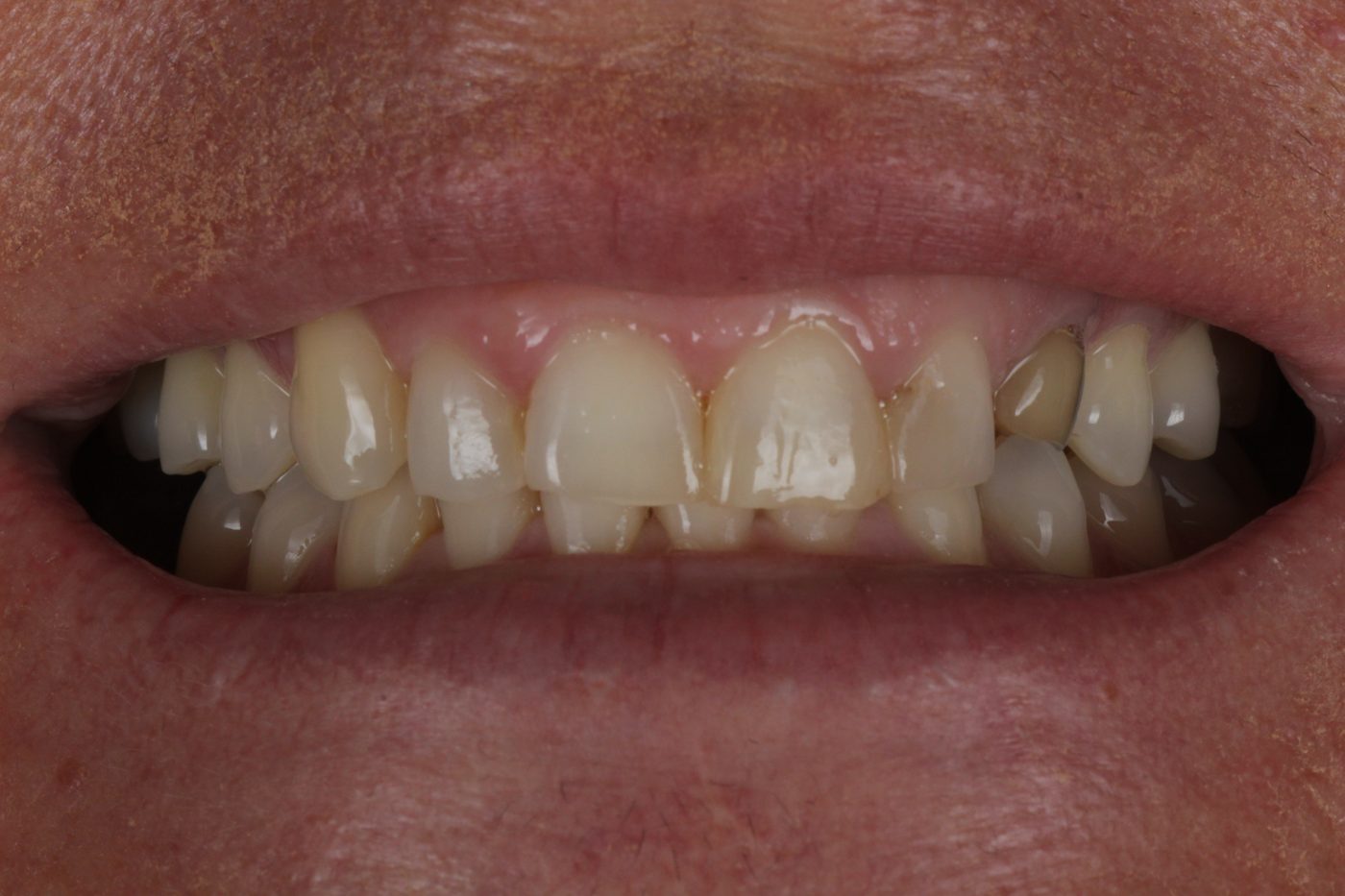 Before: smile before veneer makeover, Clermont FL