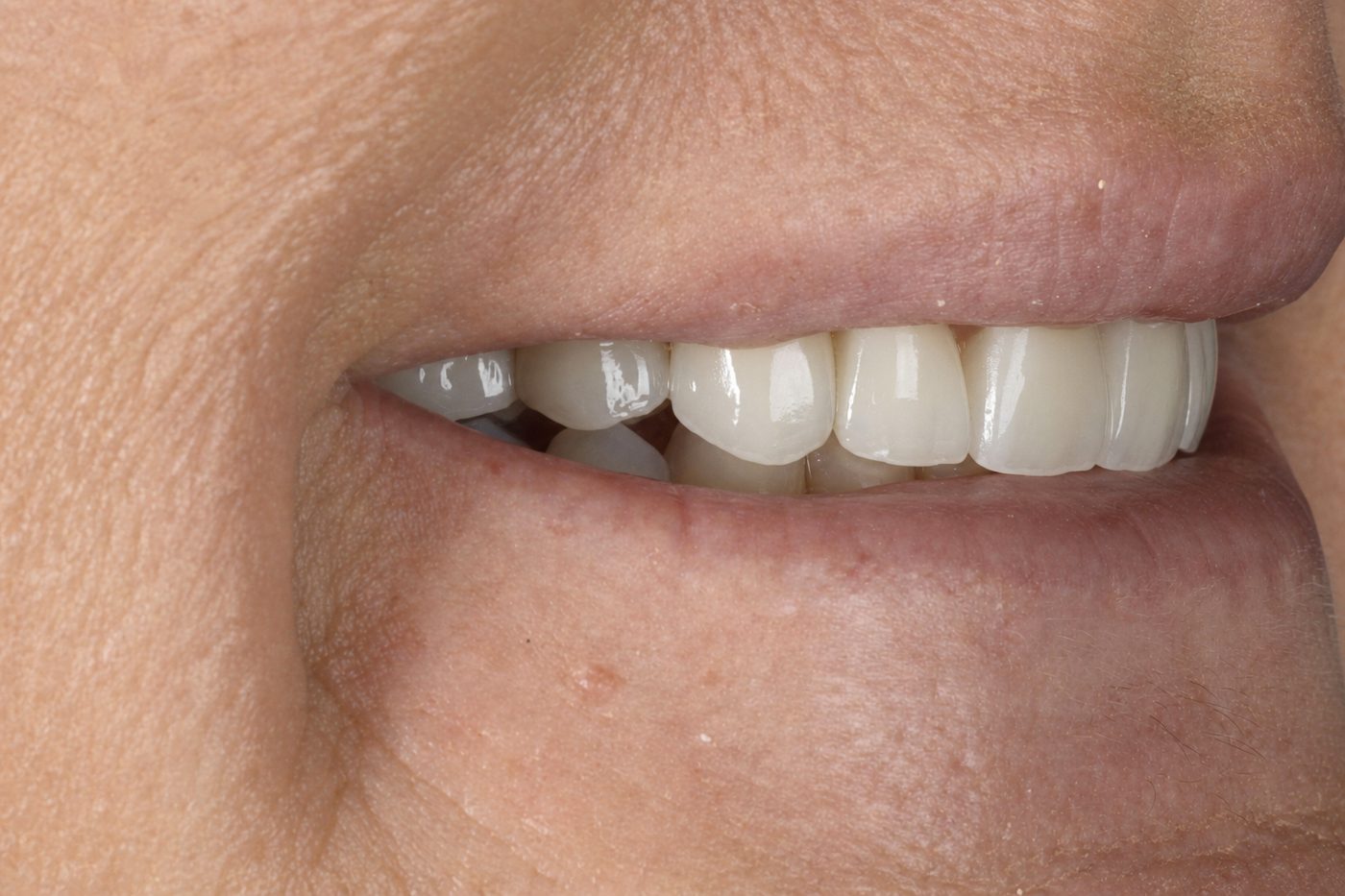 After: close-up of layered porcelain veneers, Clermont FL