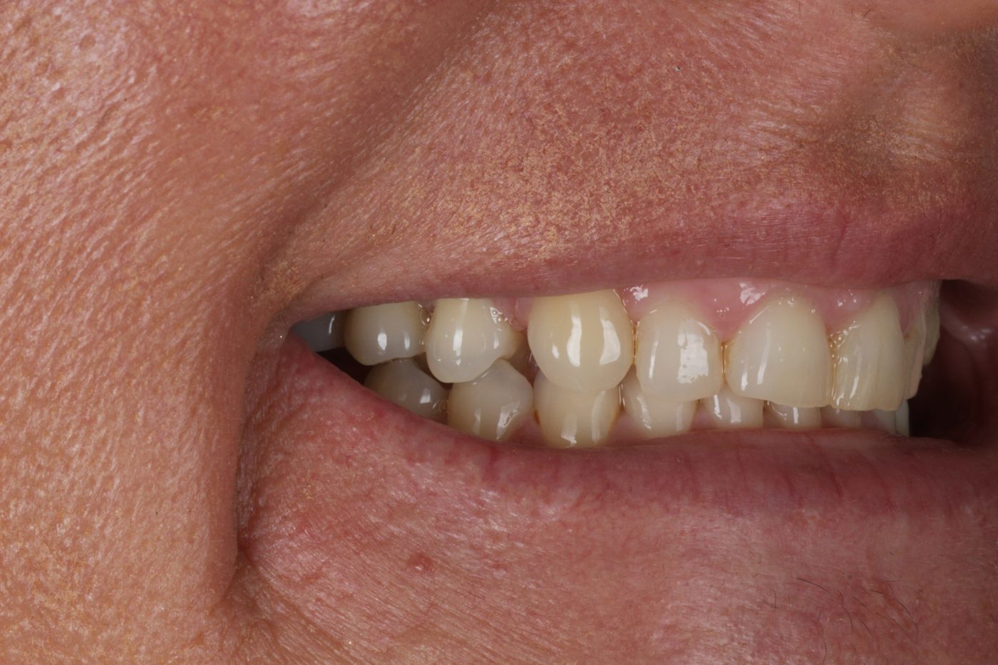 Before: close-up of teeth before veneers, Clermont FL