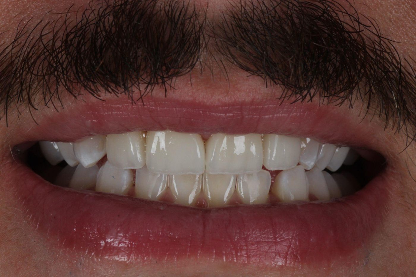 After: natural porcelain veneers, aligned confident smile, Clermont FL