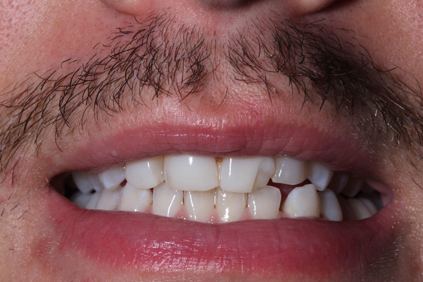 Before: chipped, crowded front teeth before porcelain veneers by Dr. Seth Calish, Clermont FL
