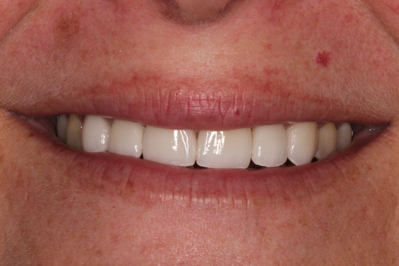 After: natural full smile rehabilitation with layered porcelain, Clermont FL