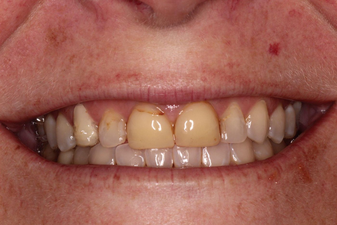 Before: discolored, failing older dental work before smile rehabilitation by Dr. Seth Calish, Clermont FL