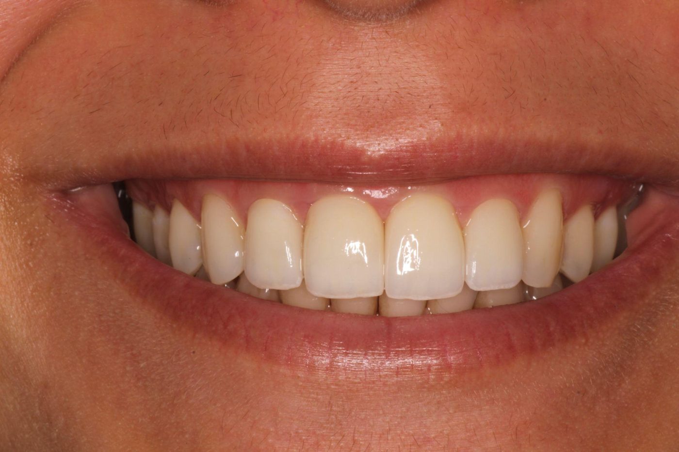 After: bright, uniform natural smile after cosmetic treatment, Clermont FL