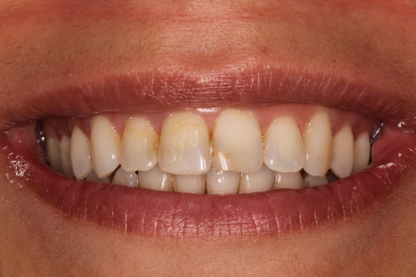 Before: stained, patched front teeth before cosmetic treatment, Clermont FL