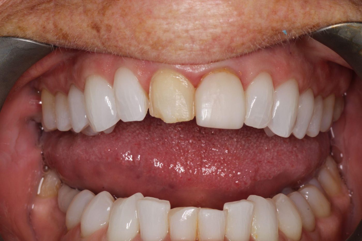 Before: single discolored front tooth before treatment by Dr. Seth Calish, Clermont FL