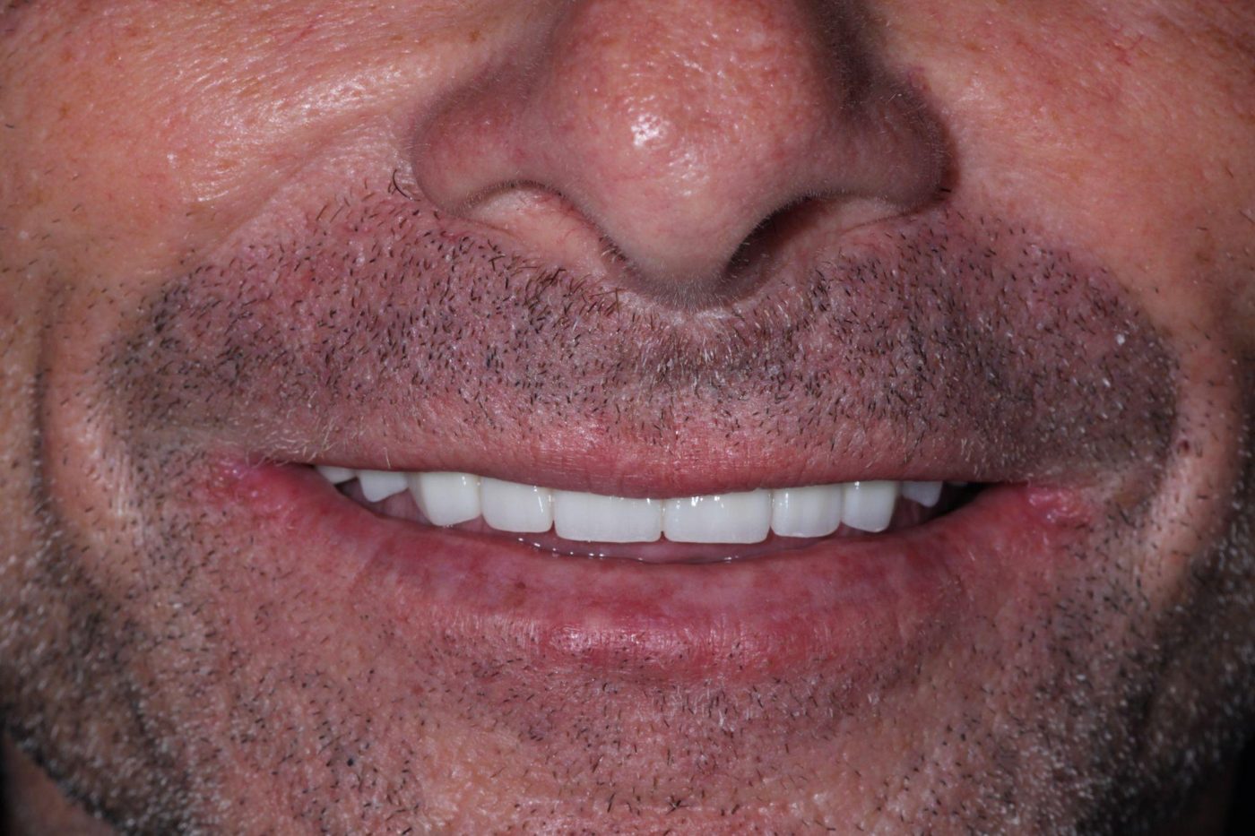 After: fixed natural-looking full-arch smile after reconstruction by Dr. Seth Calish, Clermont FL