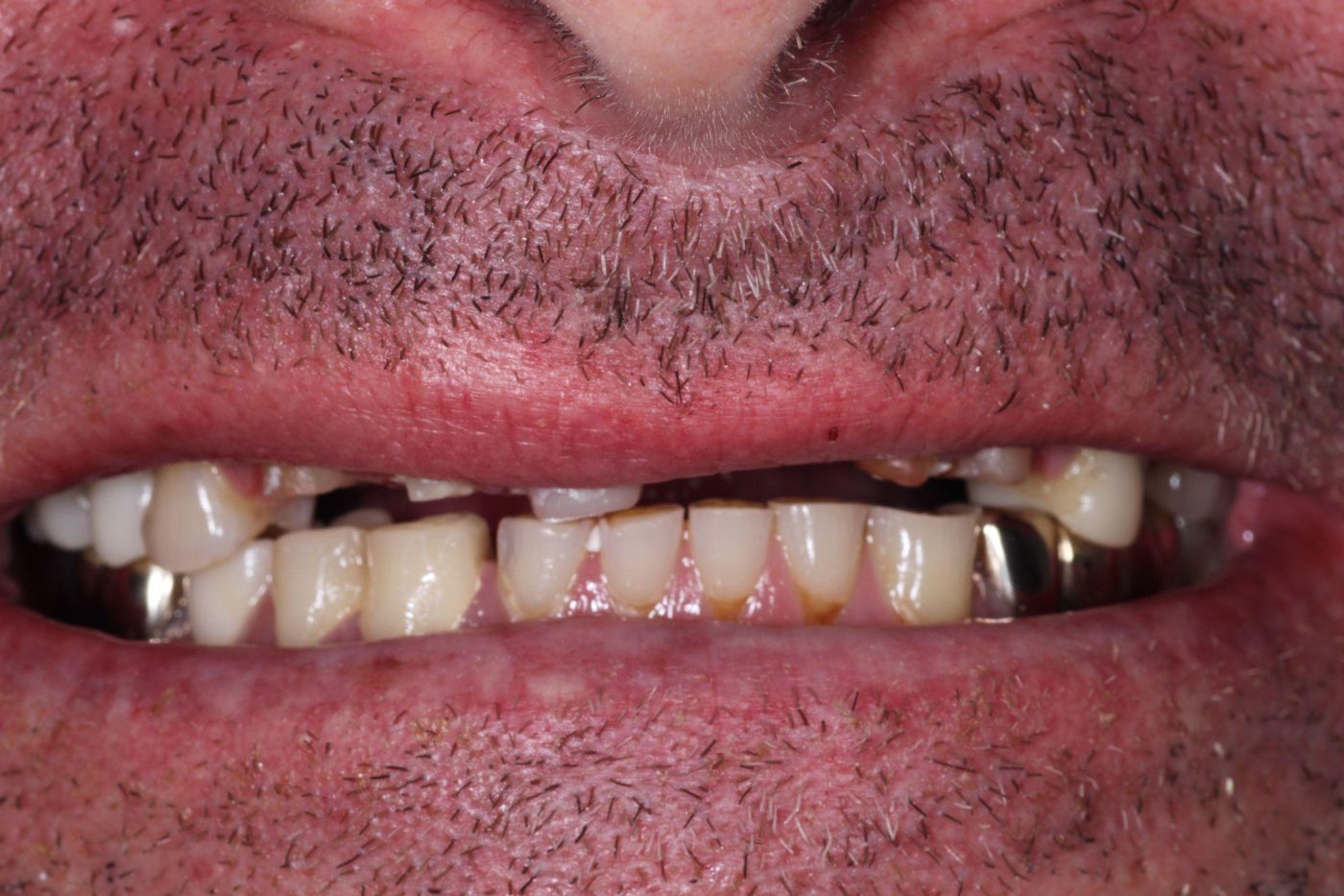 Before: severe dental breakdown and missing teeth before full-mouth reconstruction, Clermont FL