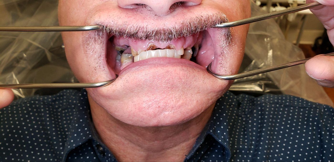 Before: failing teeth prior to implant smile makeover by Dr. Seth Calish, Clermont FL