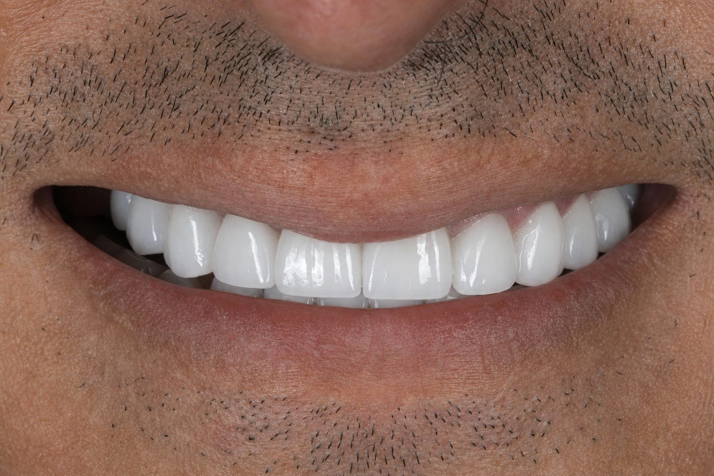 After: refined natural smile after porcelain veneers, Clermont FL