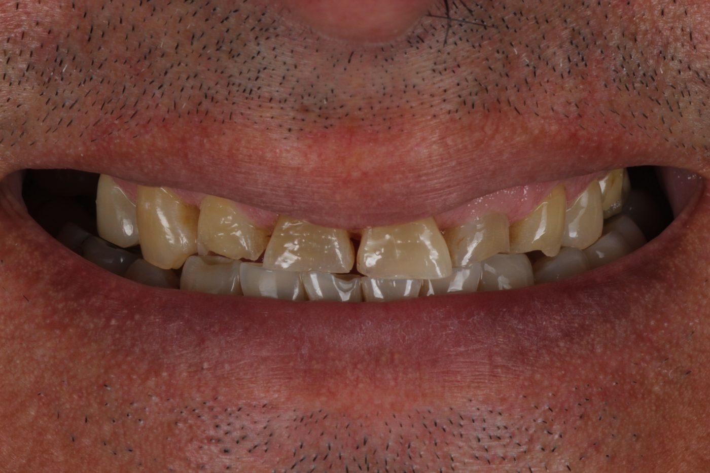 Before: smile before conservative veneer treatment, Clermont FL