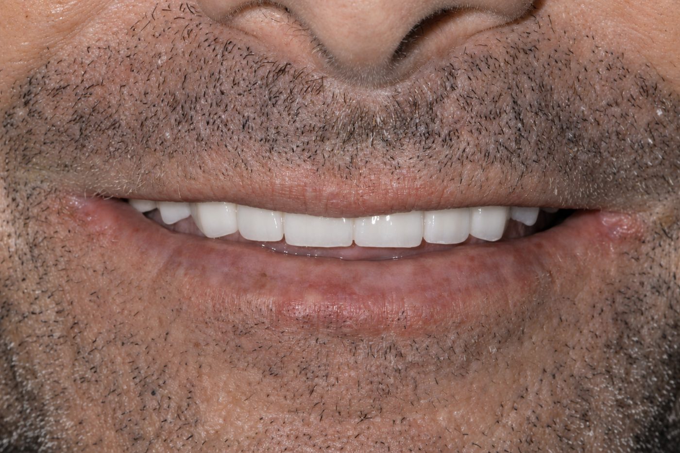 After: confident natural veneer smile, Clermont FL