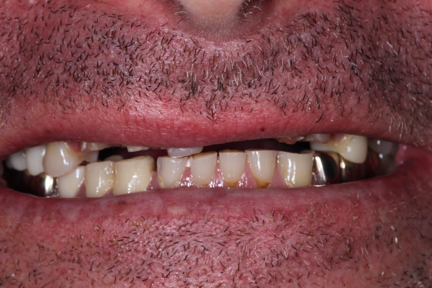 Before: smile before veneer makeover by Dr. Seth Calish