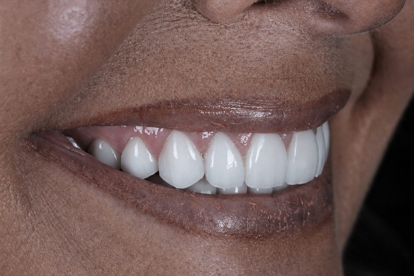 After: side view of natural porcelain veneers by Dr. Seth Calish