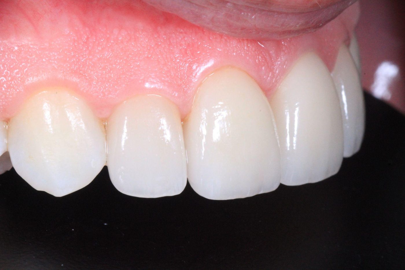 Close-up detail of layered porcelain veneers with natural translucency by Dr. Seth Calish