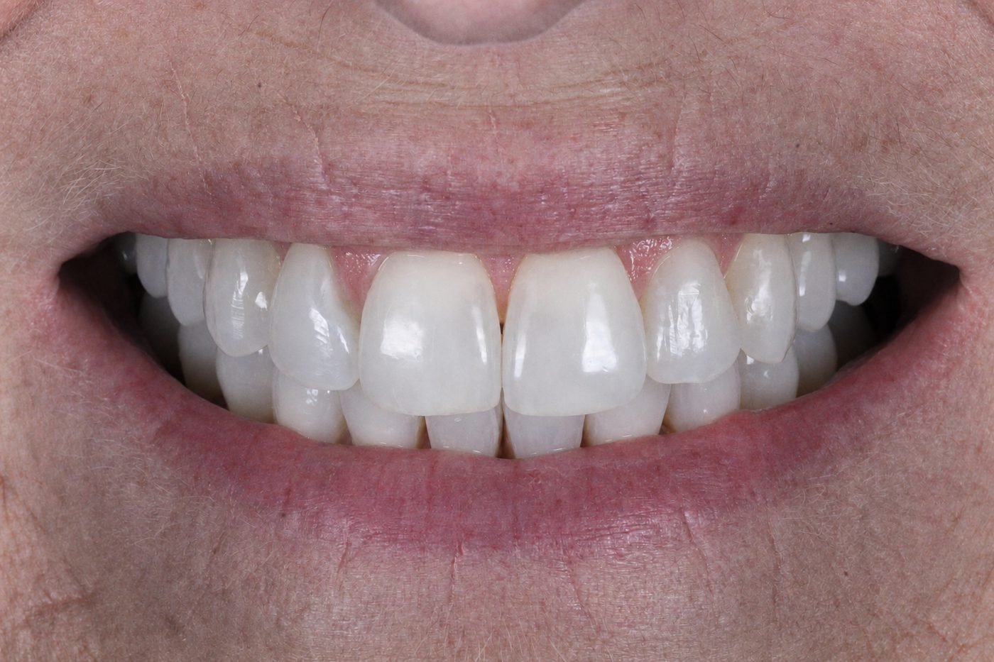After: straight natural smile after clear aligners, Clermont FL