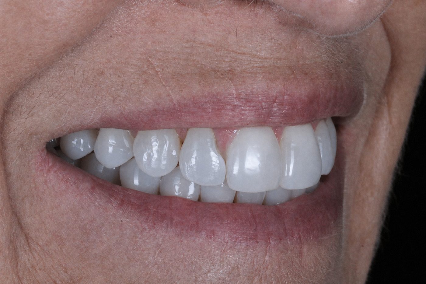 After: straight natural smile after clear aligners, no veneers needed, Clermont FL